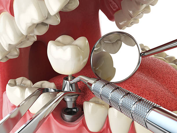 Best Emergency Wisdom Tooth Extraction in Ballwin, MO